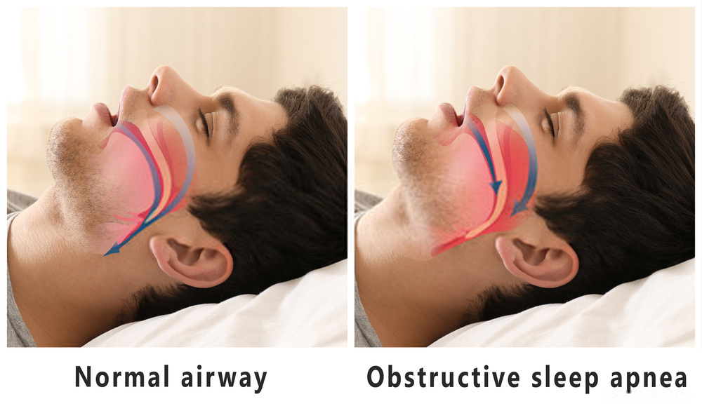 Cannabis an effective treatment for - Obstructive sleep apnea